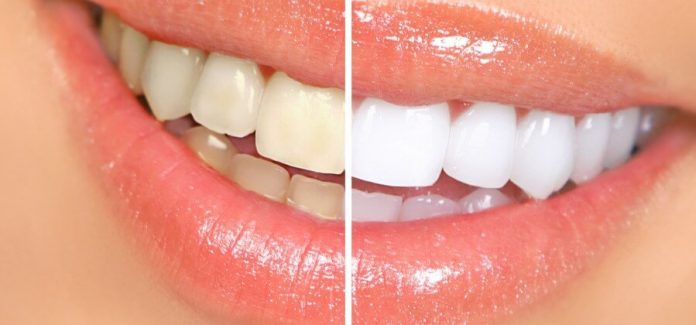 come sbiancare i denti